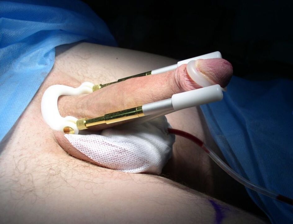 using an extender after surgery