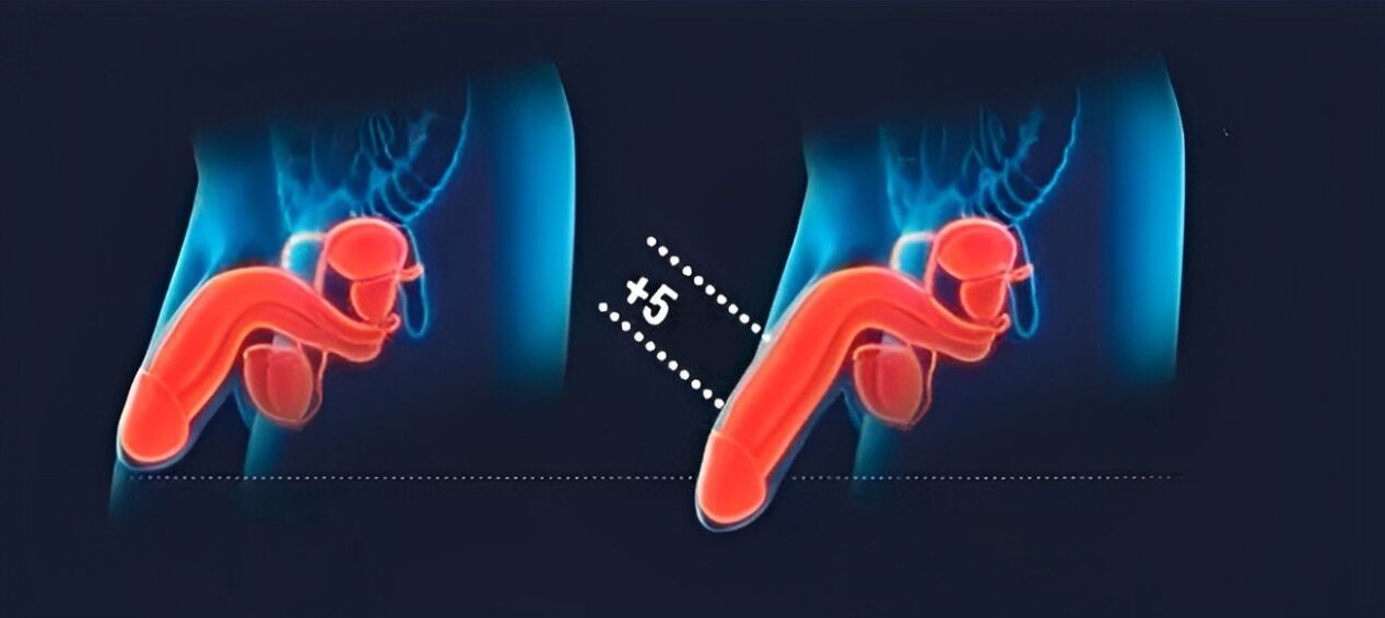 penis enlargement results with hyaluronic acid